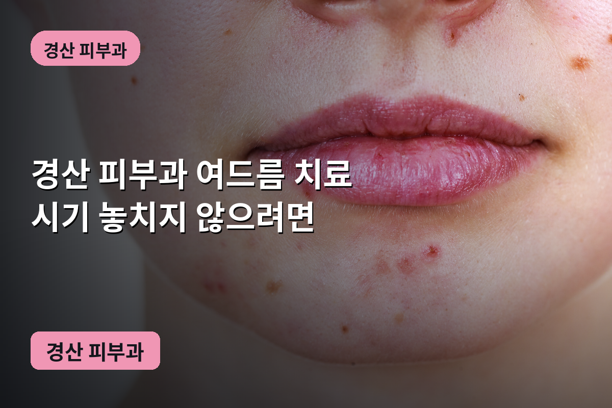 경산 피부과 여드름 치료 시기 놓치지 않으려면